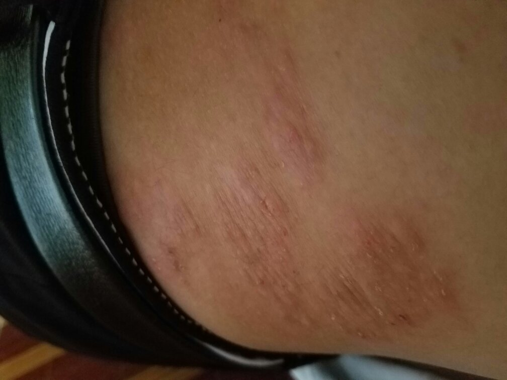 皮肤瘙痒立马痊愈 几乎不花钱