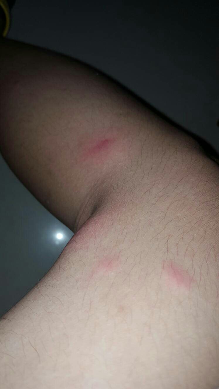 皮肤瘙痒立马痊愈 几乎不花钱