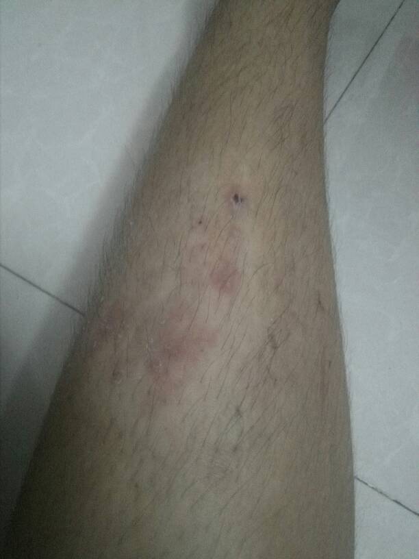 皮肤瘙痒立马痊愈 几乎不花钱