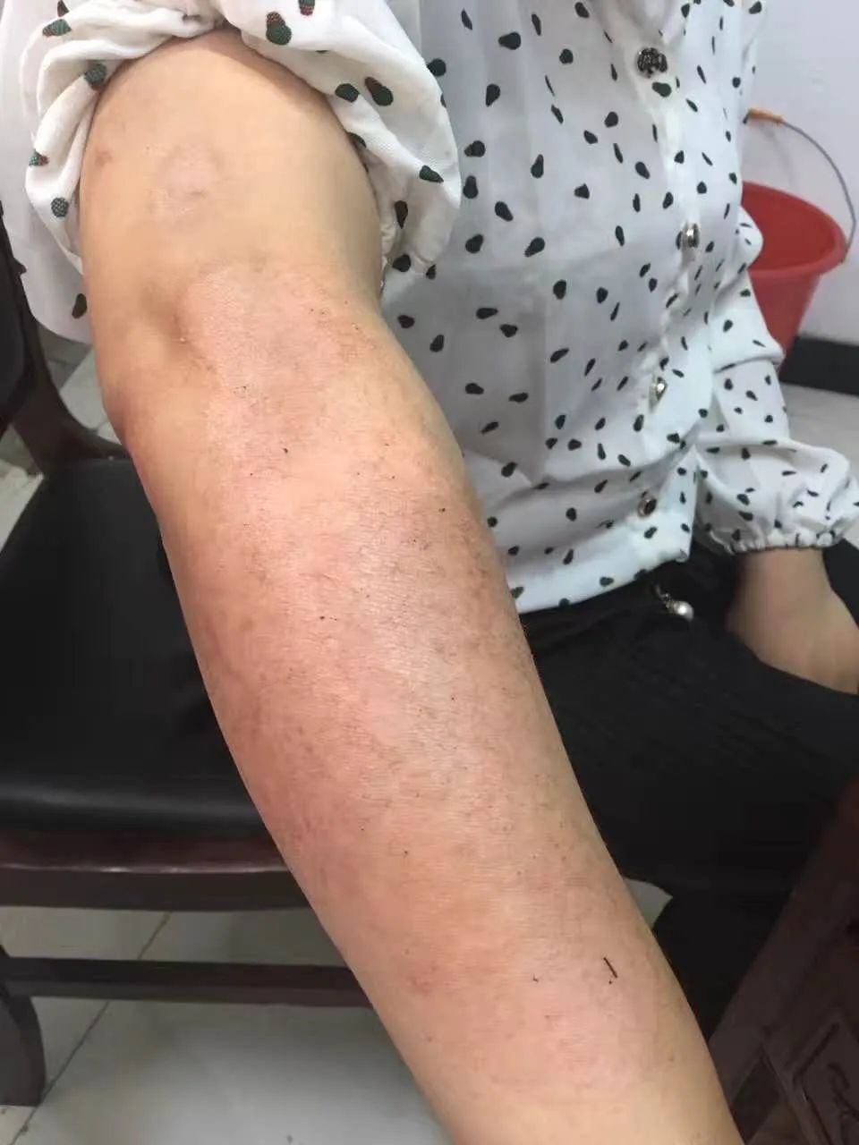 血热只是一种症状而不是病