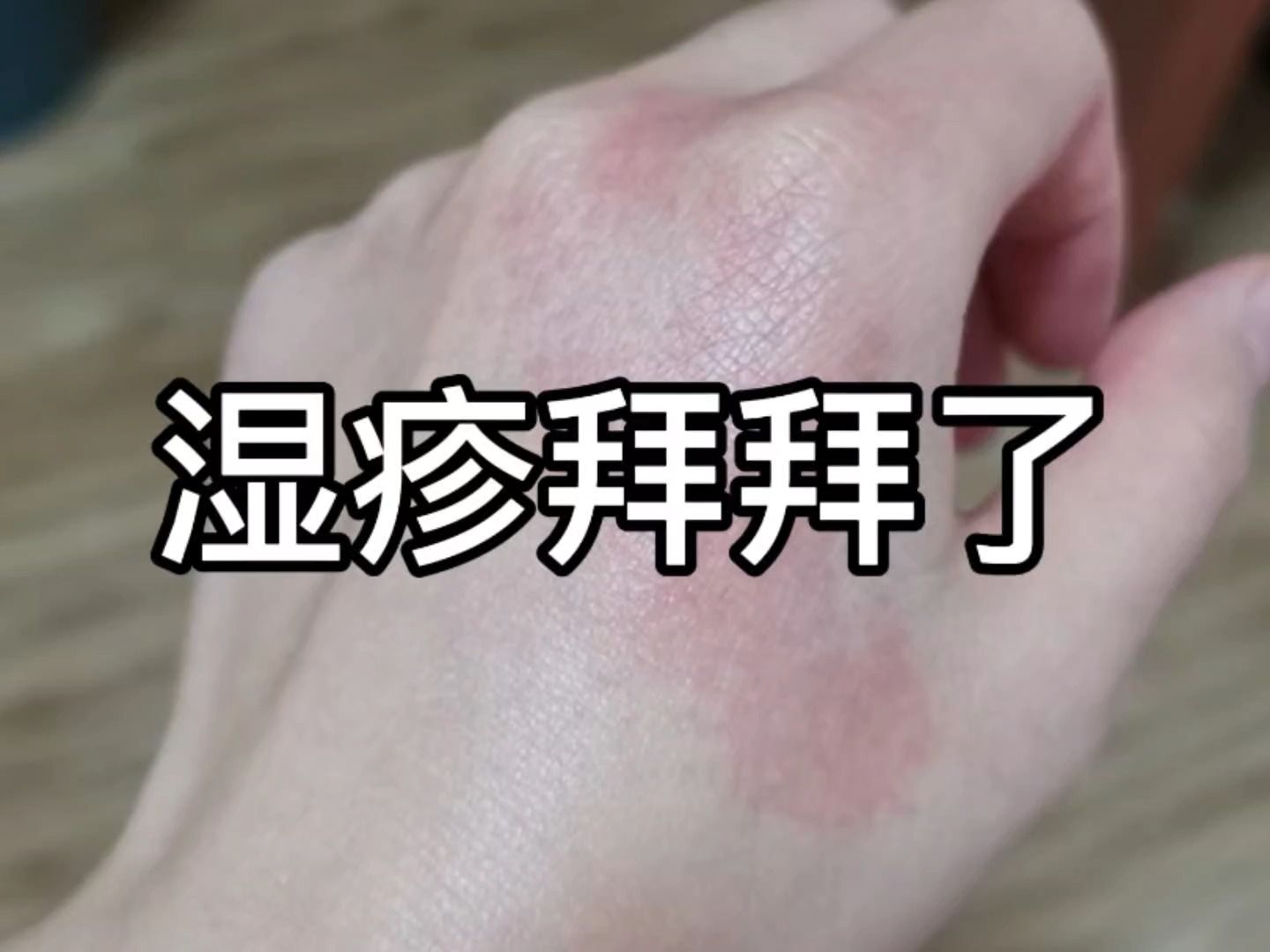 土豆淀粉治湿疹