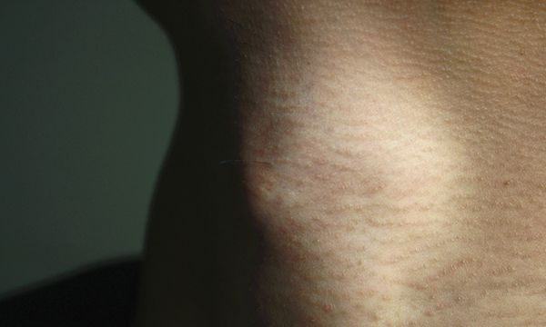 脖子上长小肉粒是怎么回事