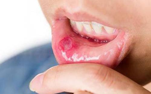 一擦就灵的口腔溃疡秘方