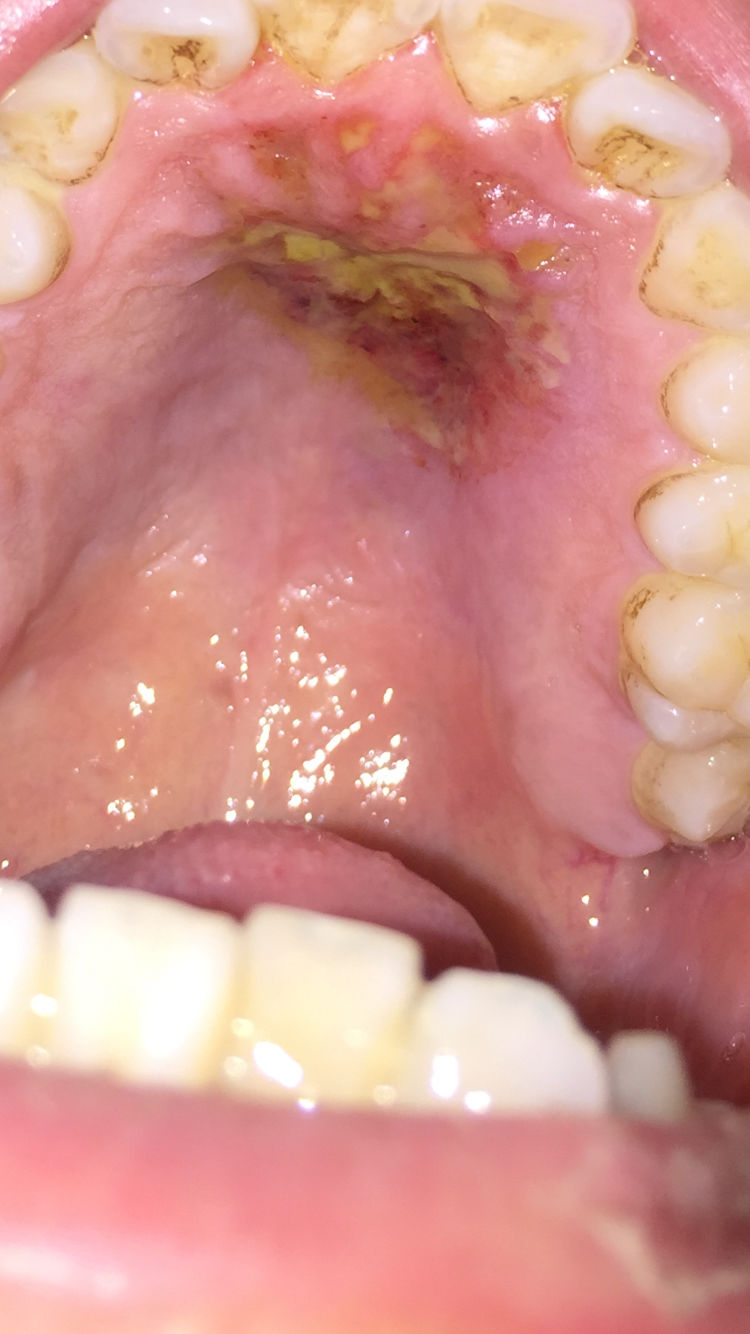 一擦就灵的口腔溃疡秘方