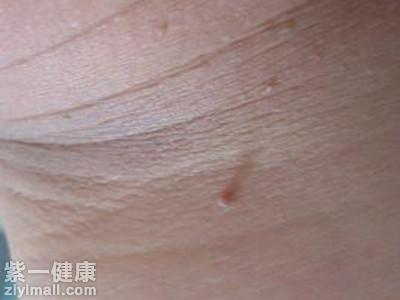 脖子上长小肉粒是怎么回事