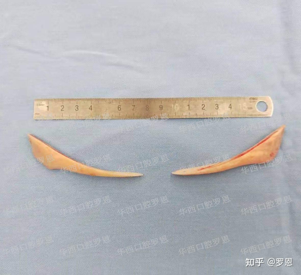 成都东部新区中西医结合医院成功实施下颌骨骨折切开复位内固定术