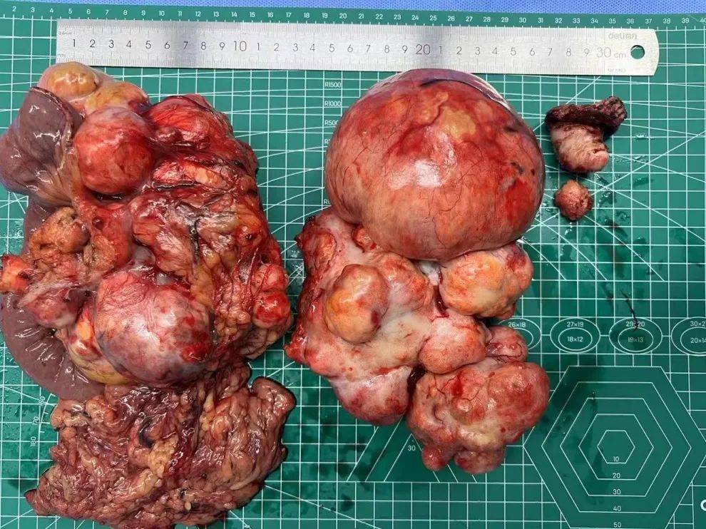 四川蓝生脑科医院成功切除直径20厘米、重10斤的巨大腹膜后肿瘤！