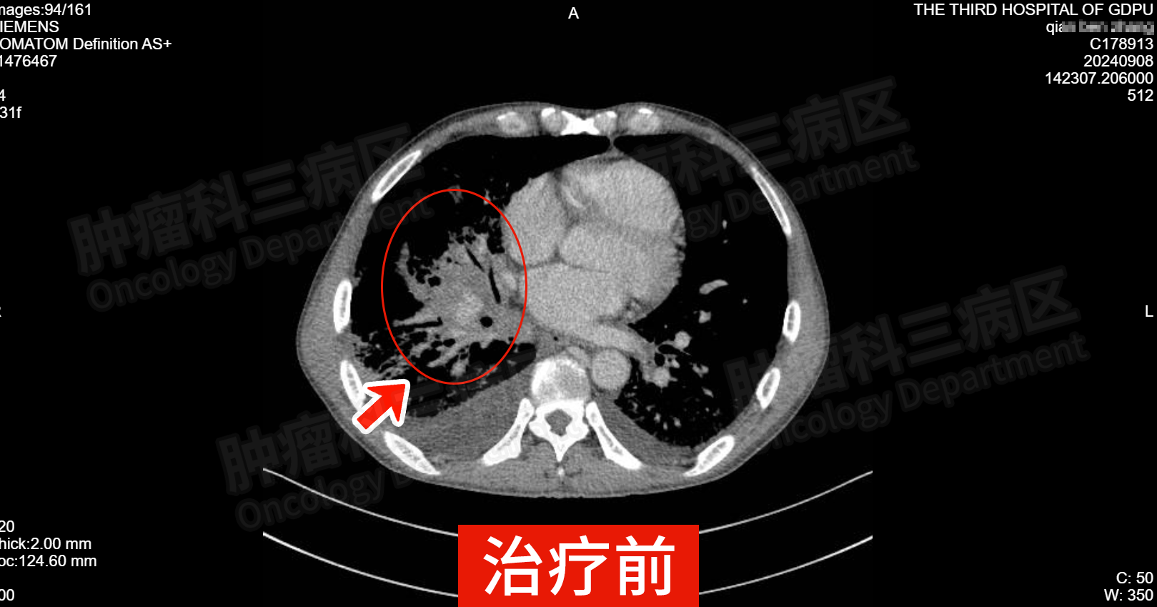 介入治肿瘤 微创新技术