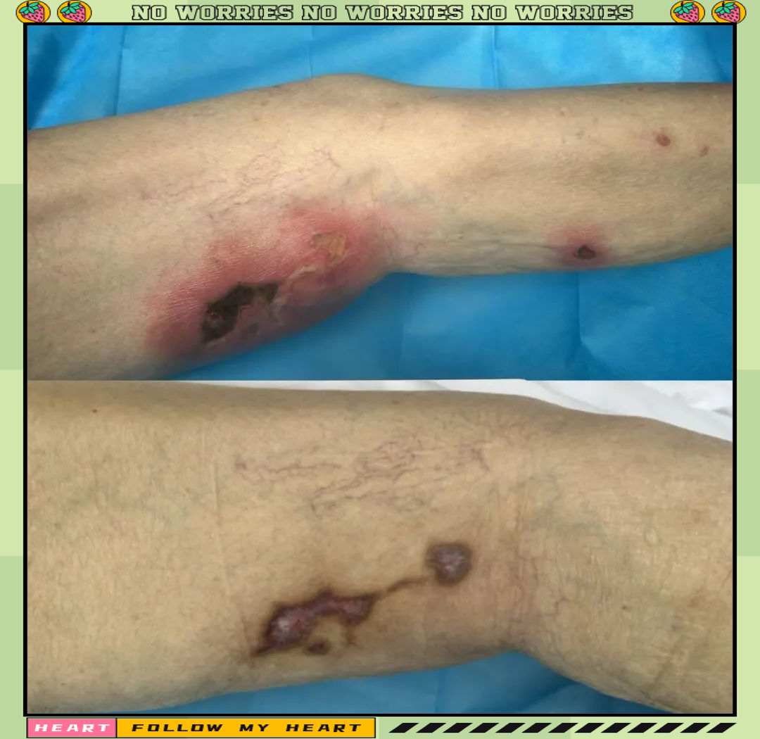 四川蓝生脑科医院伤口造口专科门诊：专业守护，伤痛无忧