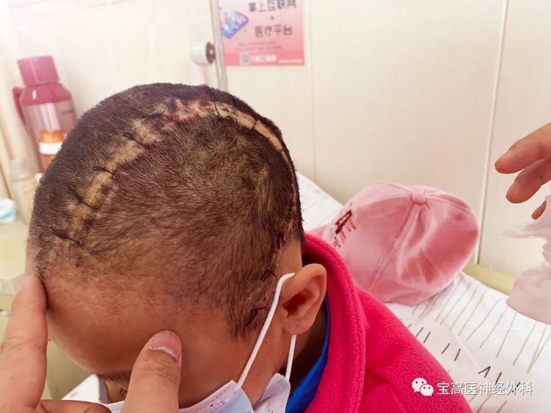 四川蓝生脑科医院PEEK颅骨修复术:重塑完整颅骨 助力患者意识复苏