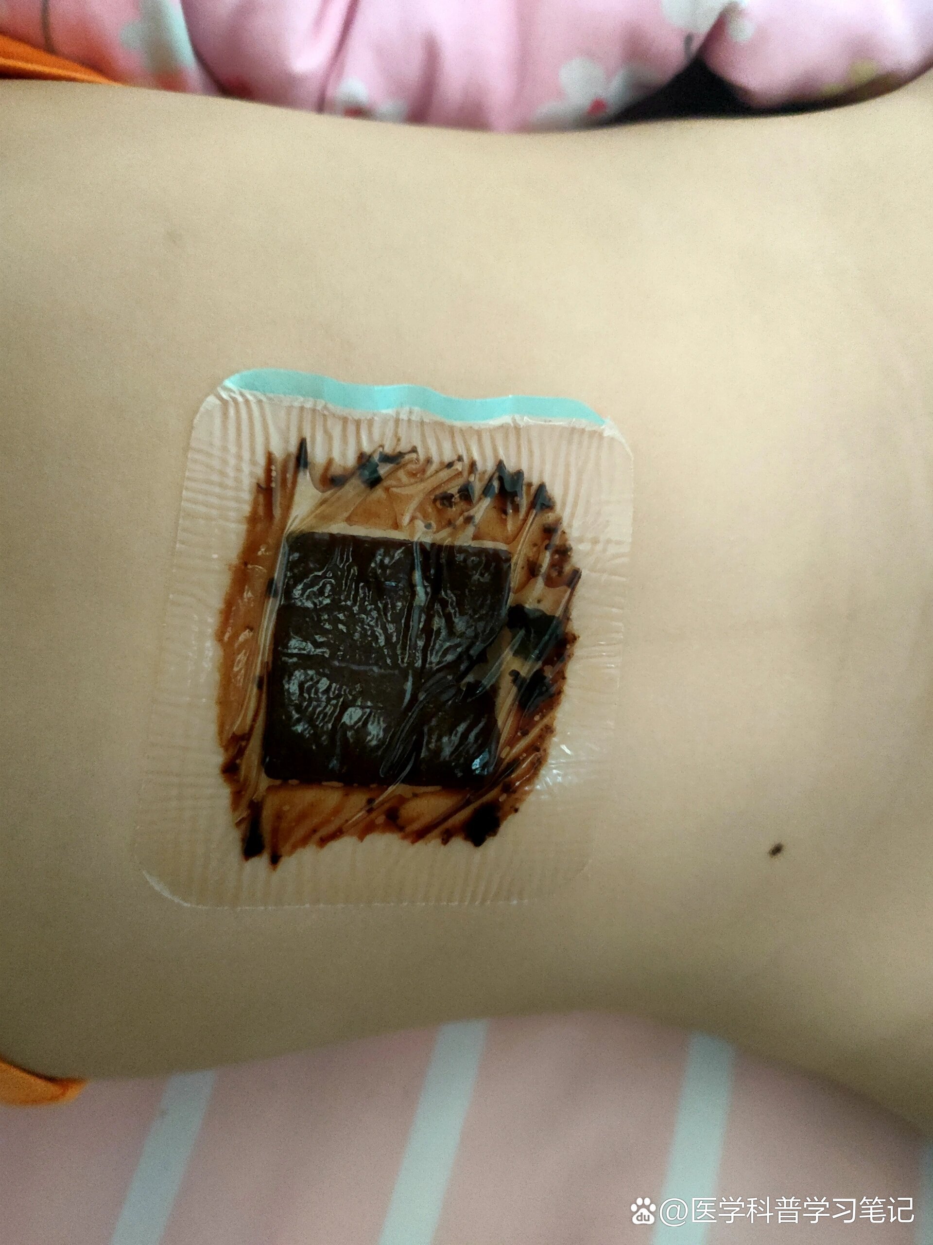 敷脐法治前列腺增生