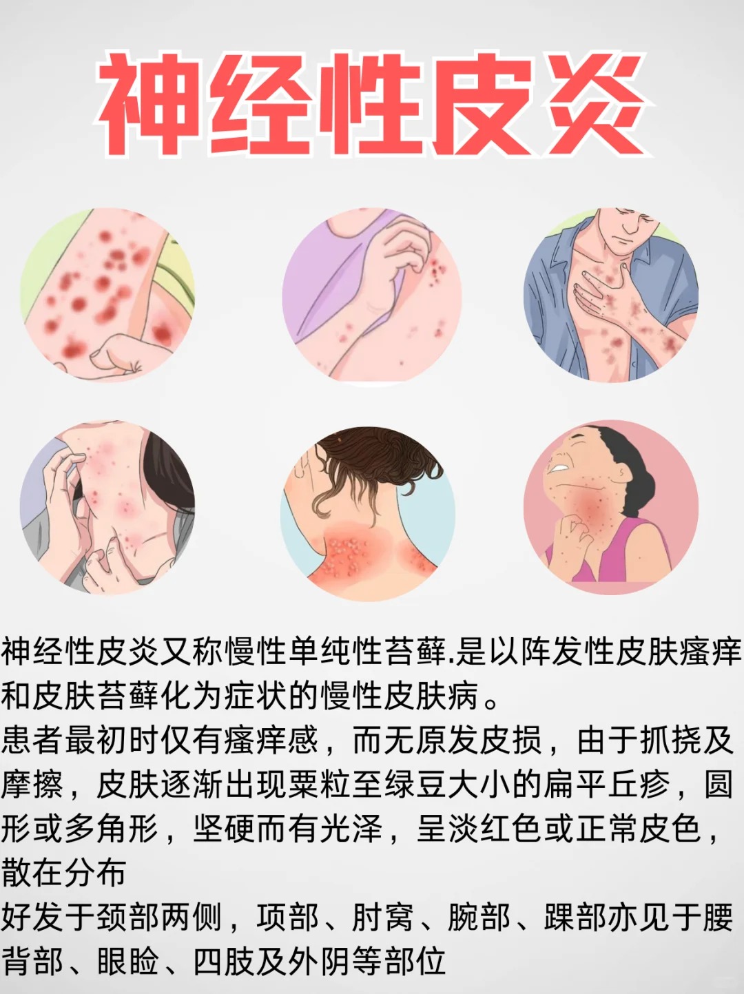 治愈神经性皮炎的4个简效方